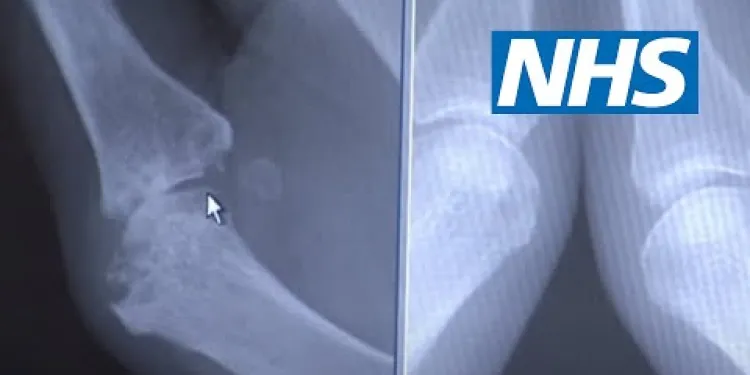 Rheumatoid arthritis | NHS