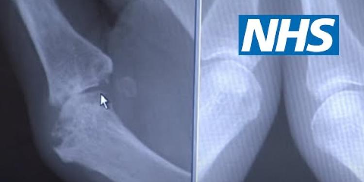 Rheumatoid arthritis | NHS