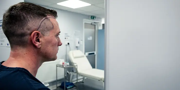 When will I see the final results of my hair transplant from Turkey?