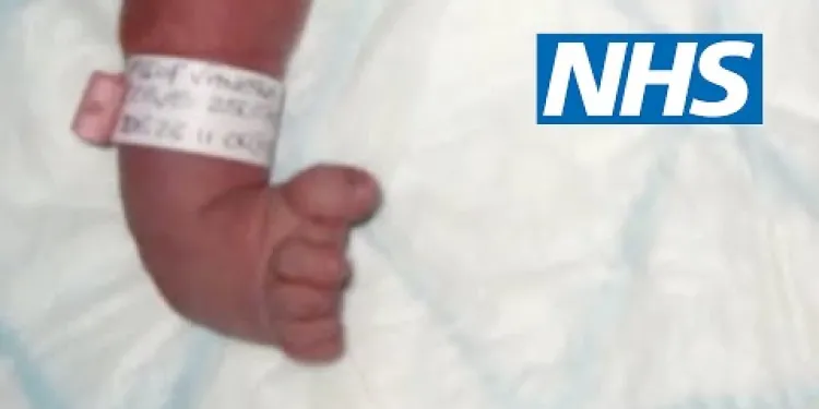 Club foot | NHS